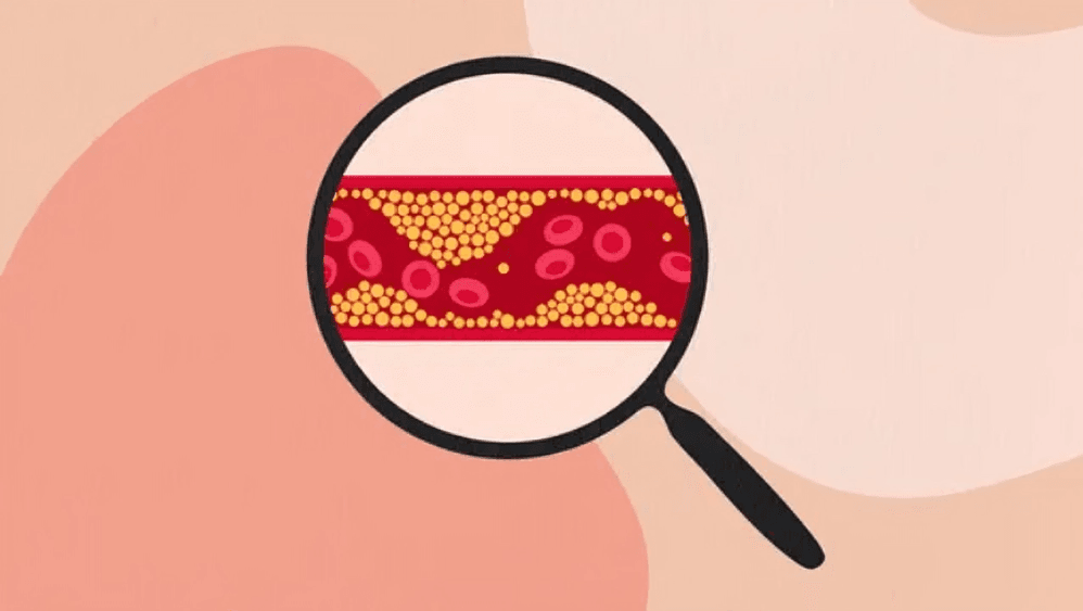 Magnifying glass showing clogged artery with cholesterol.