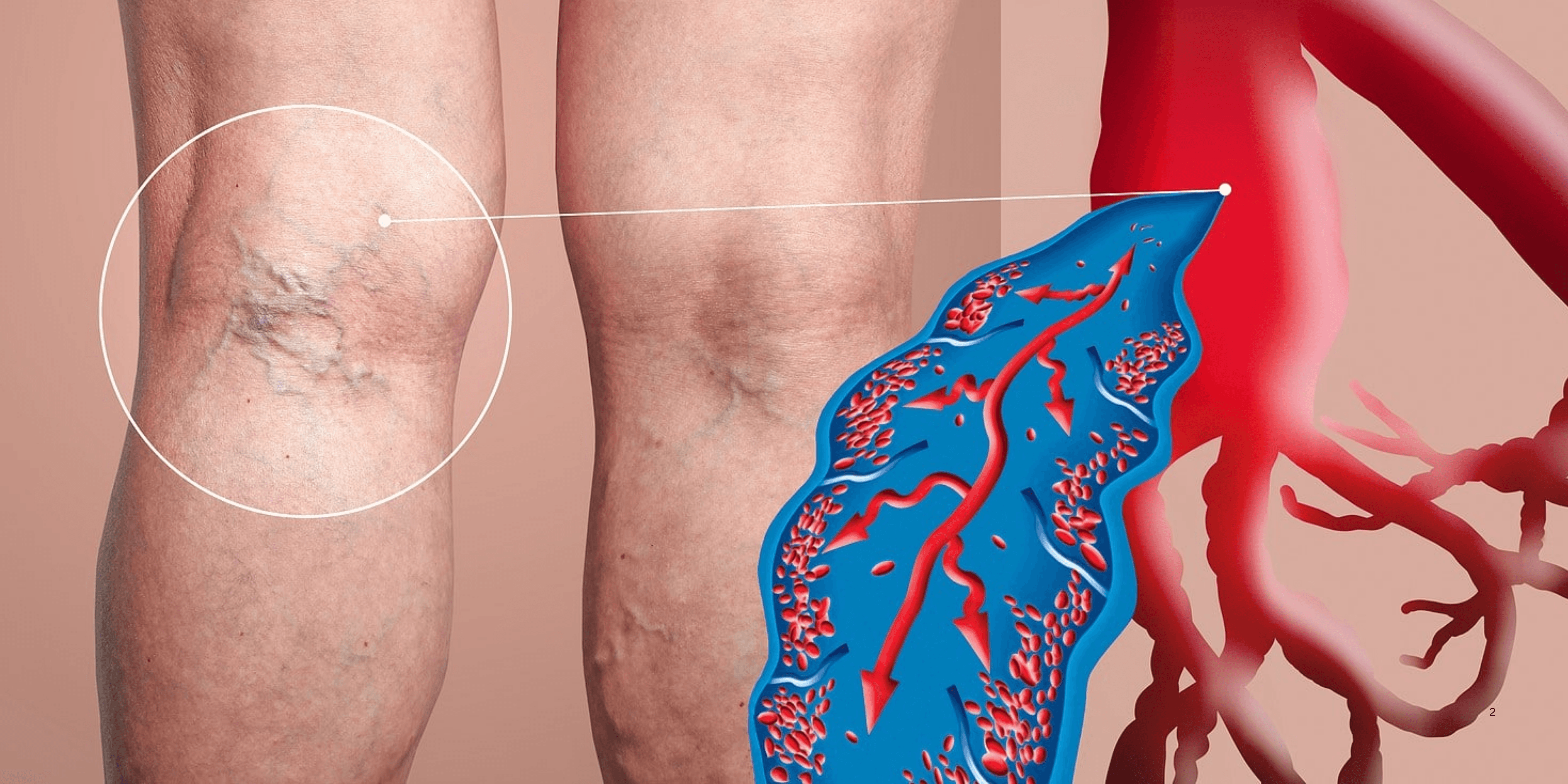 An illustration showing varicose veins and an enlarged blood vessel.