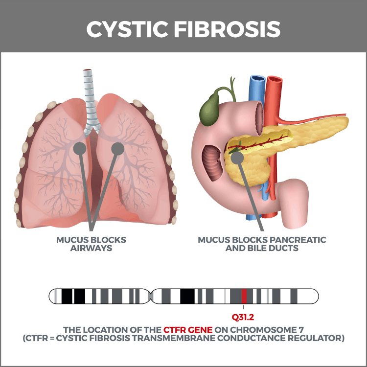 Diagram illustrating CFTR mutations causing Cystic Fibrosis.