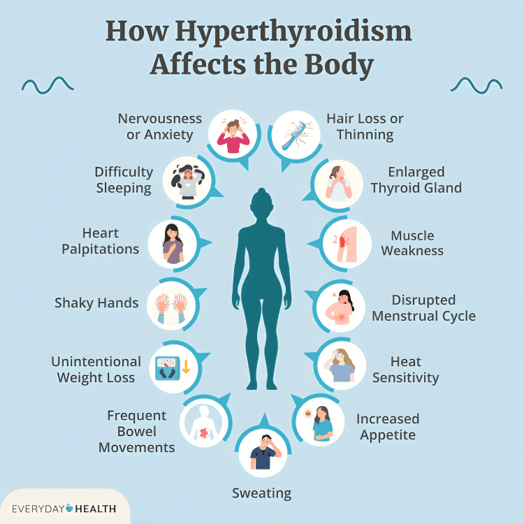 People with hyperthyroidism often experience symptoms like nervousness, rapid heartbeats, and increased sweating. It’s caused by excess thyroid hormones that speed up metabolism and heart rate.