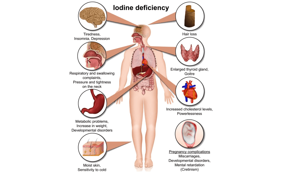 Iodine deficiency infographic showing symptoms in different body areas.