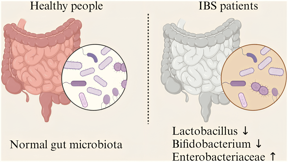 Comparison of gut microbiota in healthy people and IBS patients.