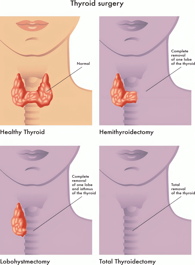 Diagram illustrating types of thyroid surgery.