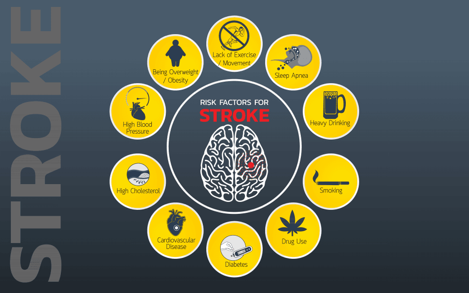 Infographic: Risk factors for stroke surrounding a brain icon.