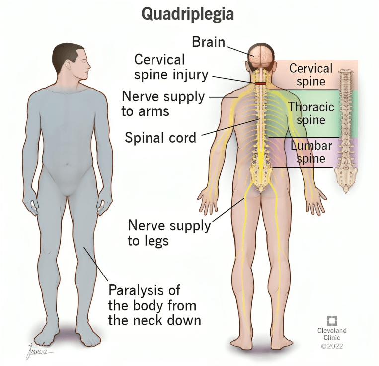 Quadriplegia showing spinal cord injury and paralysis.