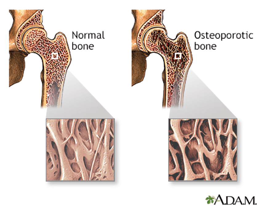 Normal versus osteoporotic bone comparison.