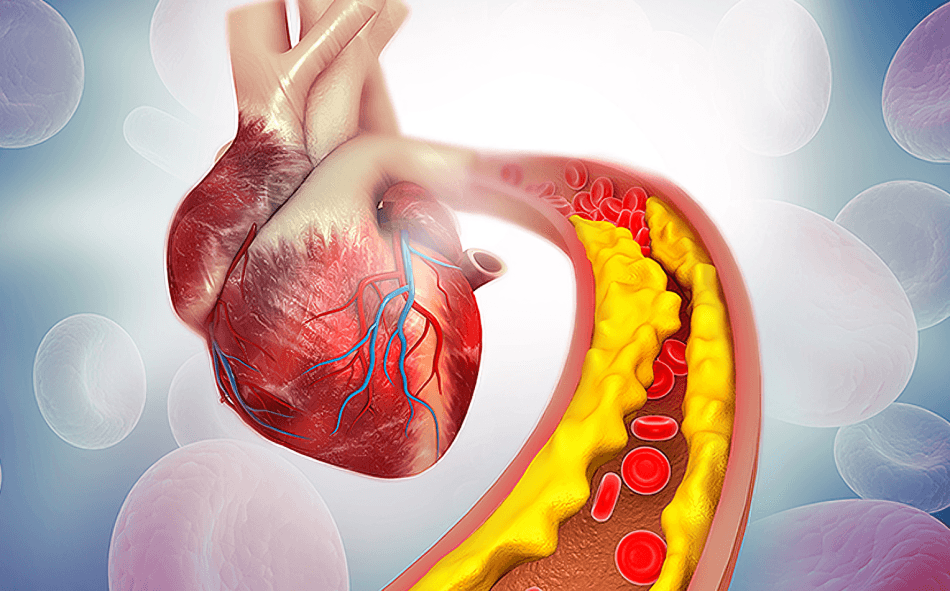 Heart and artery showing cholesterol buildup, possibly an atherosclerosis illustration.