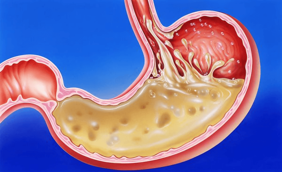 Cross-section illustration of stomach with digestive fluids.