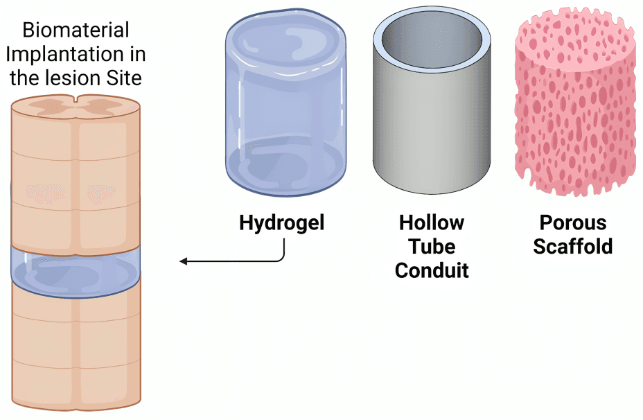 Biomaterial implantation: hydrogel, tube, scaffold for lesion.