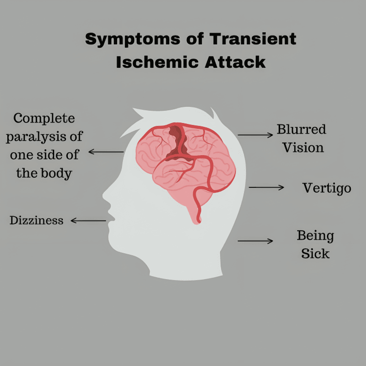 Symptoms of Transient Ischemic Attack (TIA) illustrated on a head.