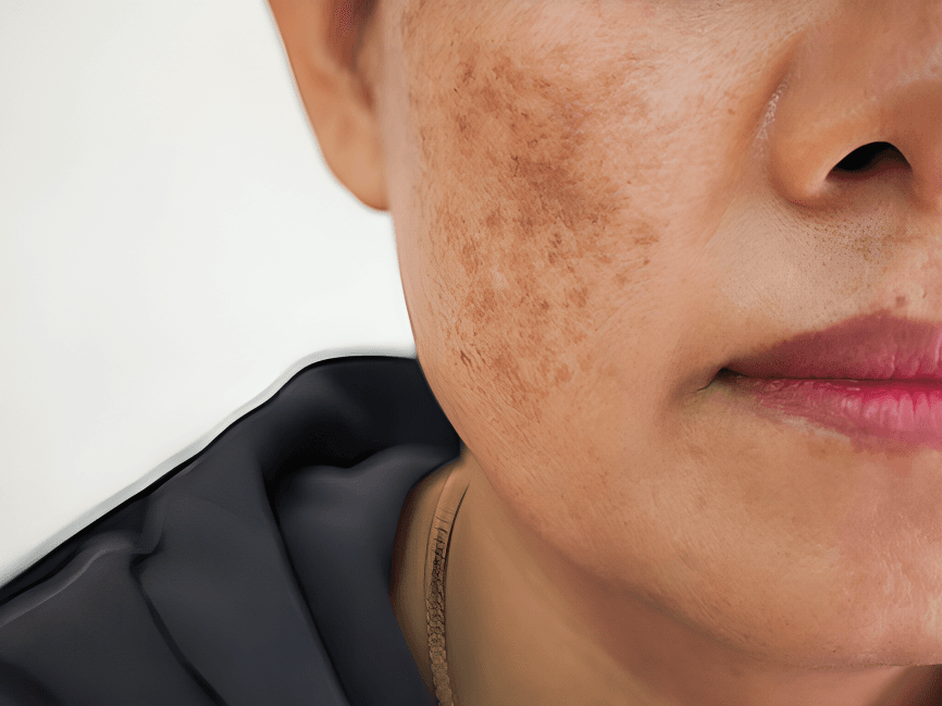 Close-up of a person's face with hyperpigmentation.