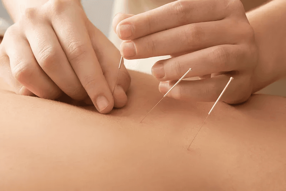 Close-up of acupuncture needles being inserted into a back.