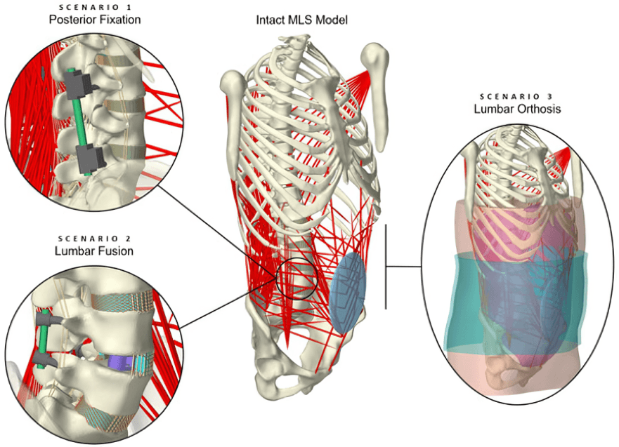 Spinal model with fixation, fusion, and orthosis scenarios.