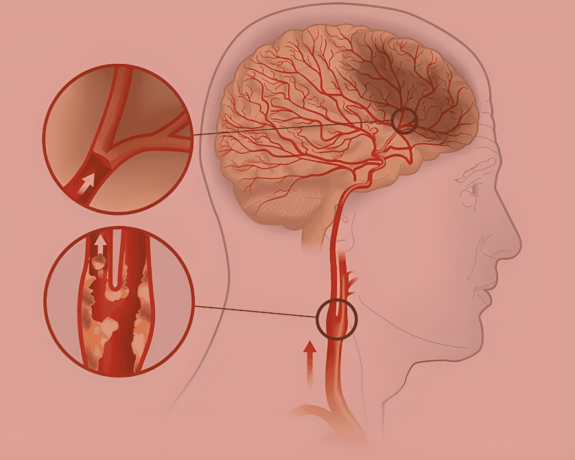 A diagram of blood flow to the brain, healthy versus blocked.