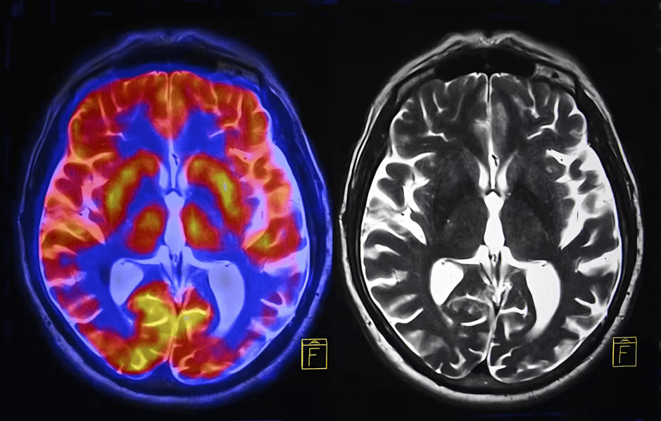 Medical scans showing brain activity (PET) and structure (MRI).