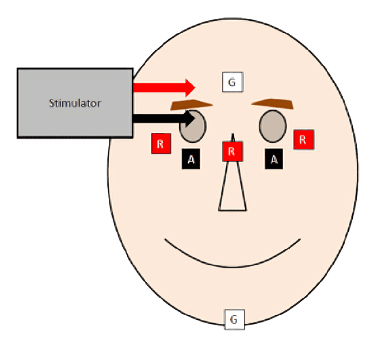 Diagram showing facial nerve stimulation with electrodes.