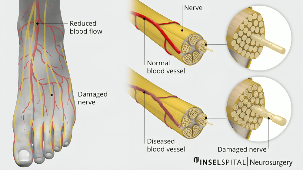 Diagram showing damaged nerves from reduced blood flow.