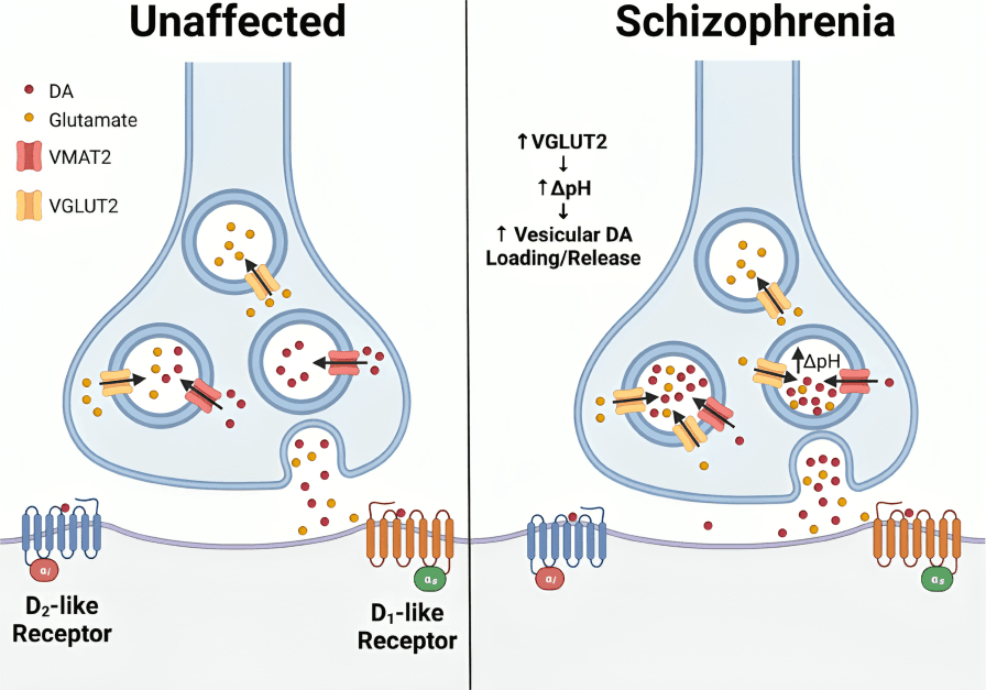 Schizophrenia: Altered dopamine and glutamate neurotransmission.
