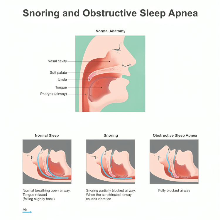 Diagram of snoring and obstructive sleep apnea with labeled anatomy.