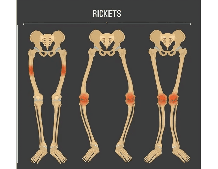 Skeletal comparison showing varying degrees of bone deformation due to rickets.