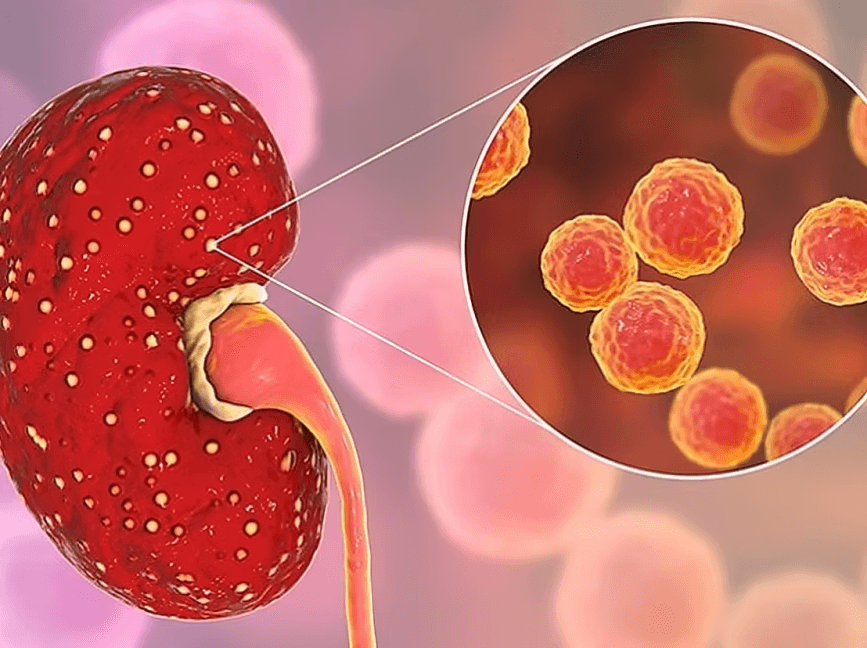 Infected kidney with numerous small lesions.