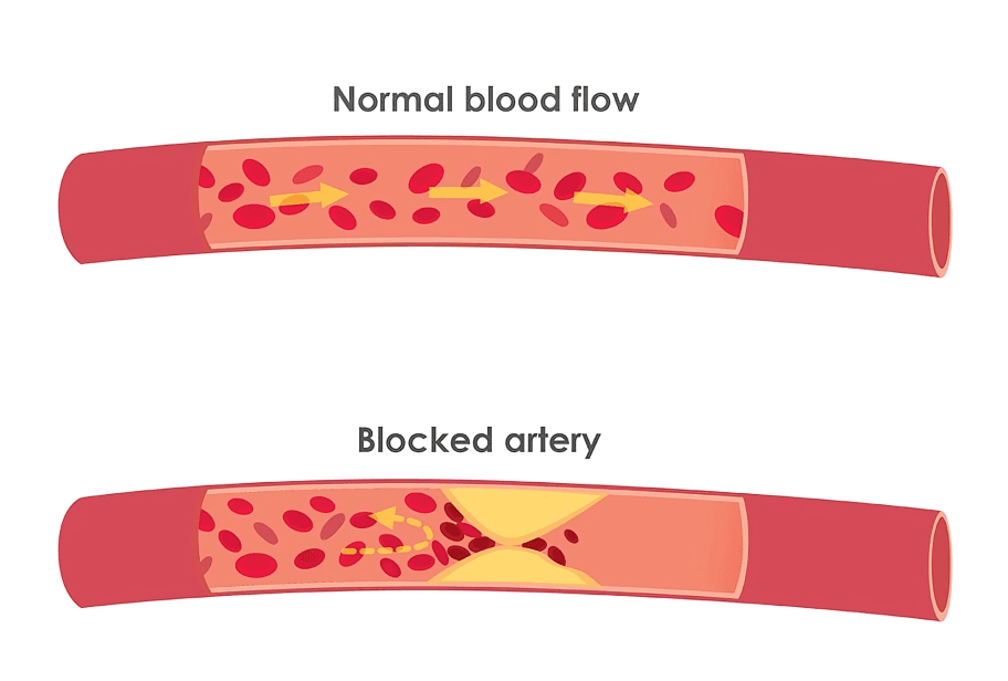 Cross-section comparing normal blood flow with a blocked artery.