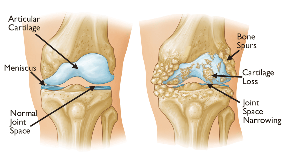 A diagram illustrating a normal knee versus a knee with osteoarthritis.