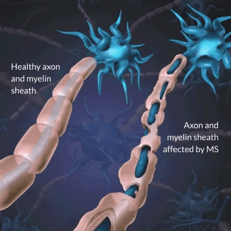 Healthy and MS affected axons with myelin.