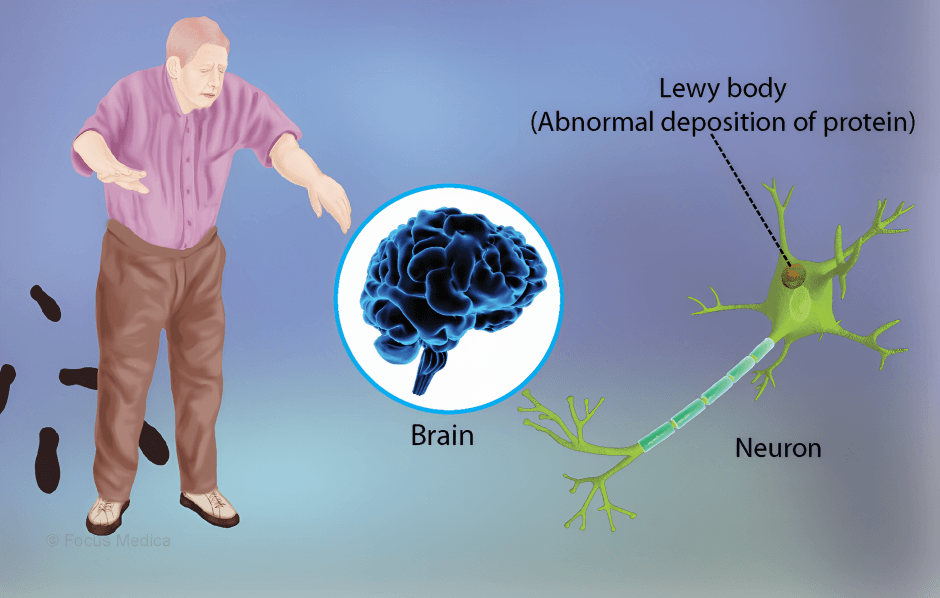 Lewy bodies, brain, neuron, and affected person.