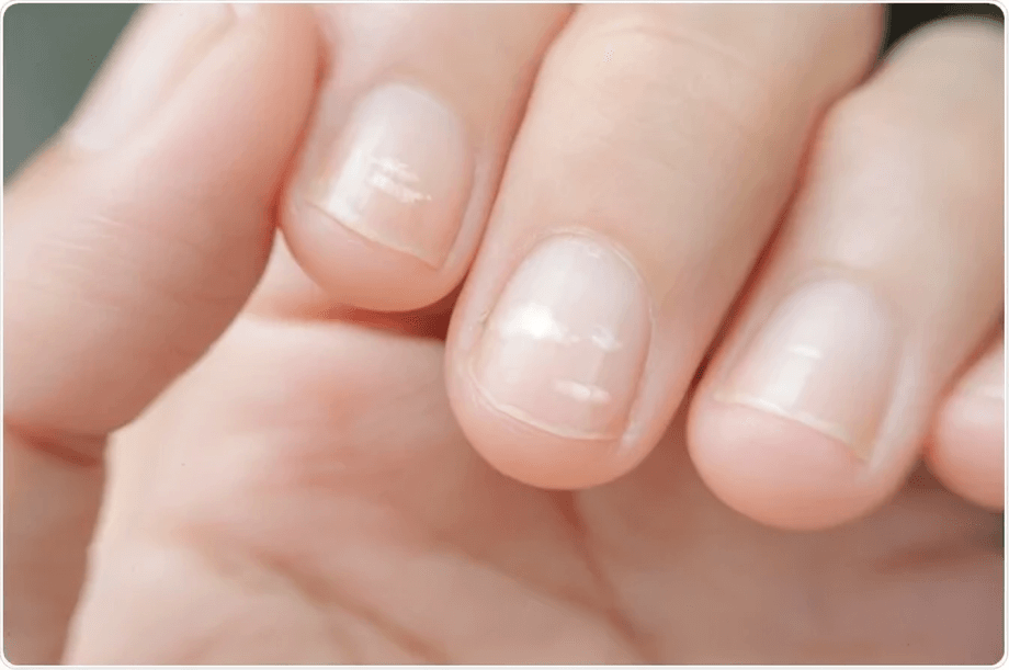 A close-up of a hand with pale nails and white spots.