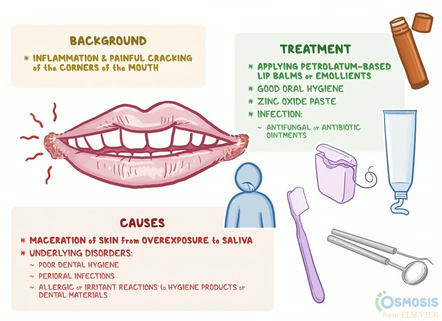 Diagram of angular cheilitis with symptoms, causes, and treatment options.