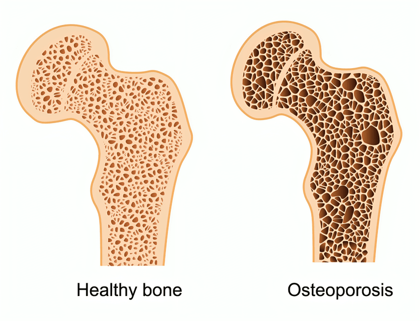 Diagram comparing healthy bone to bone with osteoporosis, side by side.