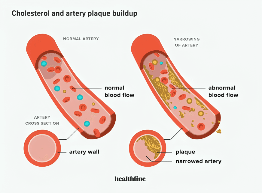 Diagram showing normal artery versus artery with plaque buildup.