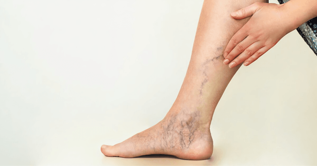 A hand touching a leg with varicose and spider veins.