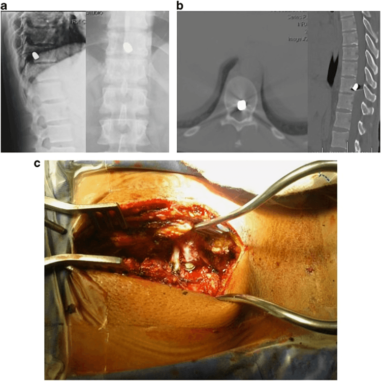 Medical imaging and surgical view of spinal bullet.