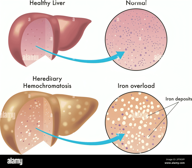 Liver comparison: healthy vs. hemochromatosis, iron overload.