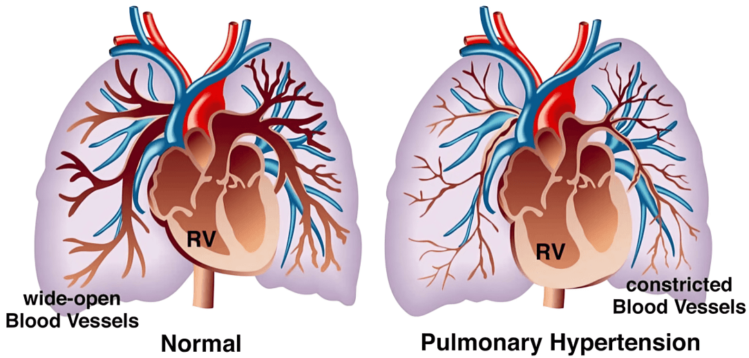 Pulmonary hypertension diagram comparing normal lungs to lungs with constricted vessels.