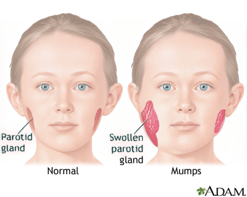 Medical illustration comparing normal and mumps-swollen parotid glands.