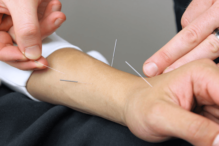 An acupuncturist inserting needles into a person's wrist and forearm.